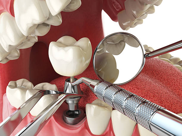 Best Knocked-Out Tooth (Avulsed Tooth) Treatment in Springfield, KY